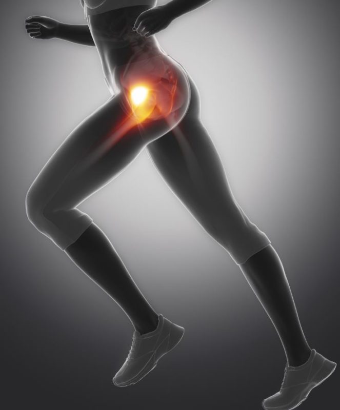 Piriformis Syndrom
