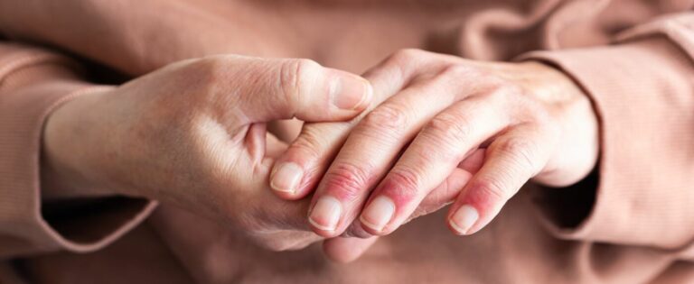 Neurodermitis an den Fingern