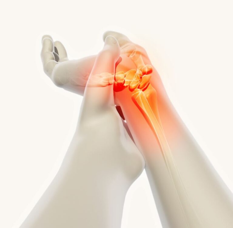 Karpaltunnelsyndrom X-Ray